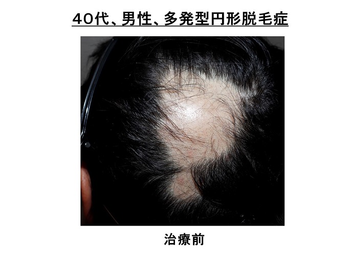 円形脱毛症　病院